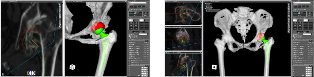 人工股関節手術の3次元コンピュータシミュレーション